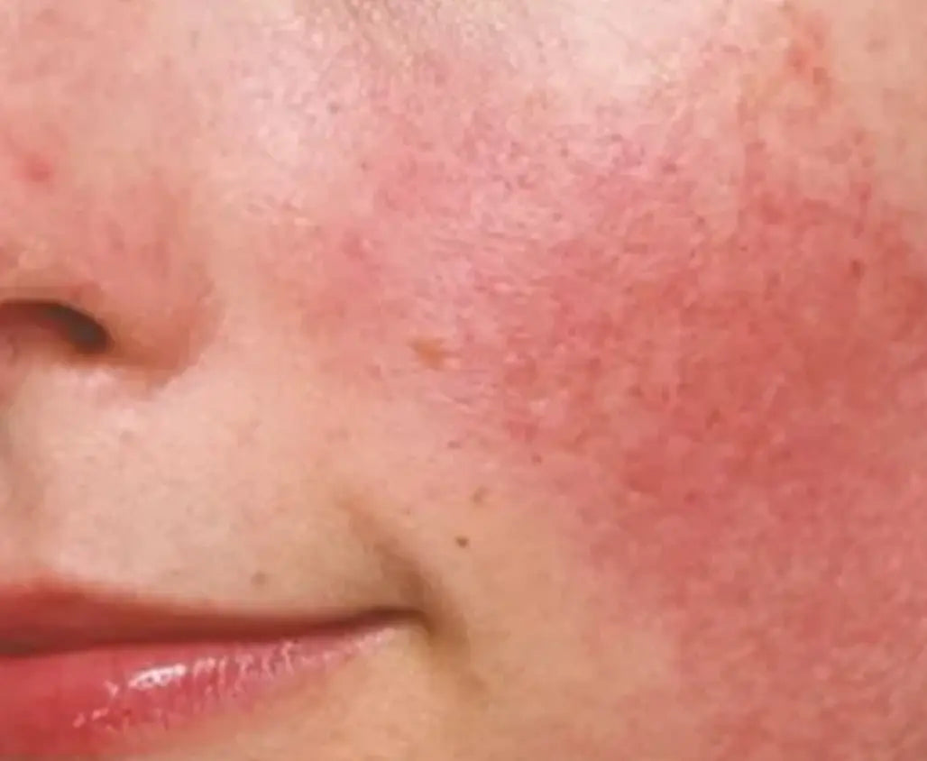 For - Skin inflammation For - Skin inflammation Kay Pedals